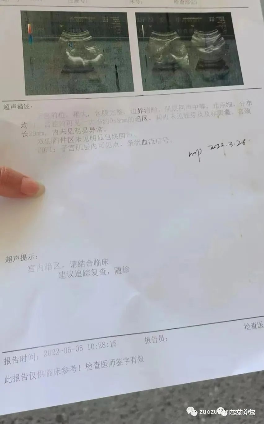 案例分享：胎停排死胎調理案例