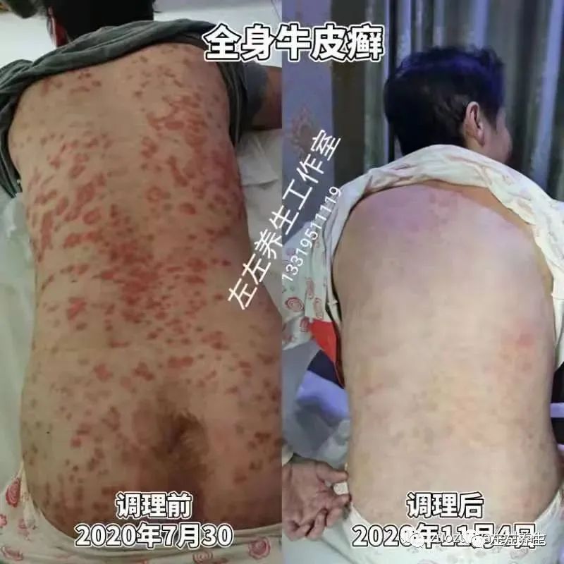 案例分享：20年牛皮癬調理案例