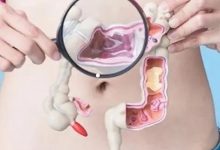 案例分享：腸梗阻住院兩天后調理案例-七不姜 生姜養生網-明德CSA生態姜園&明安農業