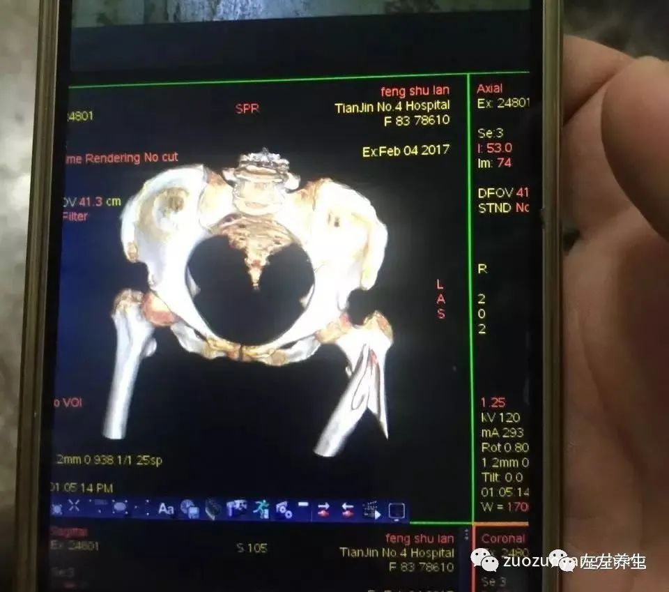 案例分享：又一奇跡：83歲婆婆骨折錯位沒開刀沒手術6周康復