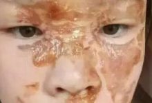 案例分享：花季少女面部燙傷不留疤的調理案例-七不姜 生姜養生網-明德CSA生態姜園&明安農業