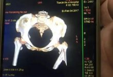 案例分享：又一奇跡：83歲婆婆骨折錯位沒開刀沒手術6周康復-七不姜 生姜養生網-明德CSA生態姜園&明安農業