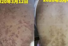 案例分享：產后高血壓、全身奇癢無比調理案例-七不姜 生姜養生網-明德CSA生態姜園&明安農業