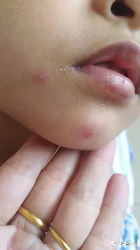 佛山原始點中心學員花開深圳：媽媽用原始點為七歲兒調理水痘9天康復案例