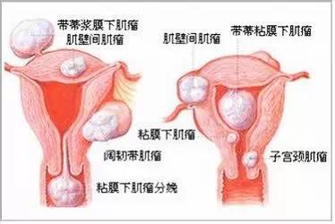 子宮肌瘤、乳腺癌原來是這么回事！看完我目瞪口呆！