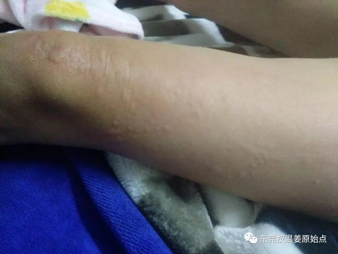小孩全身過敏