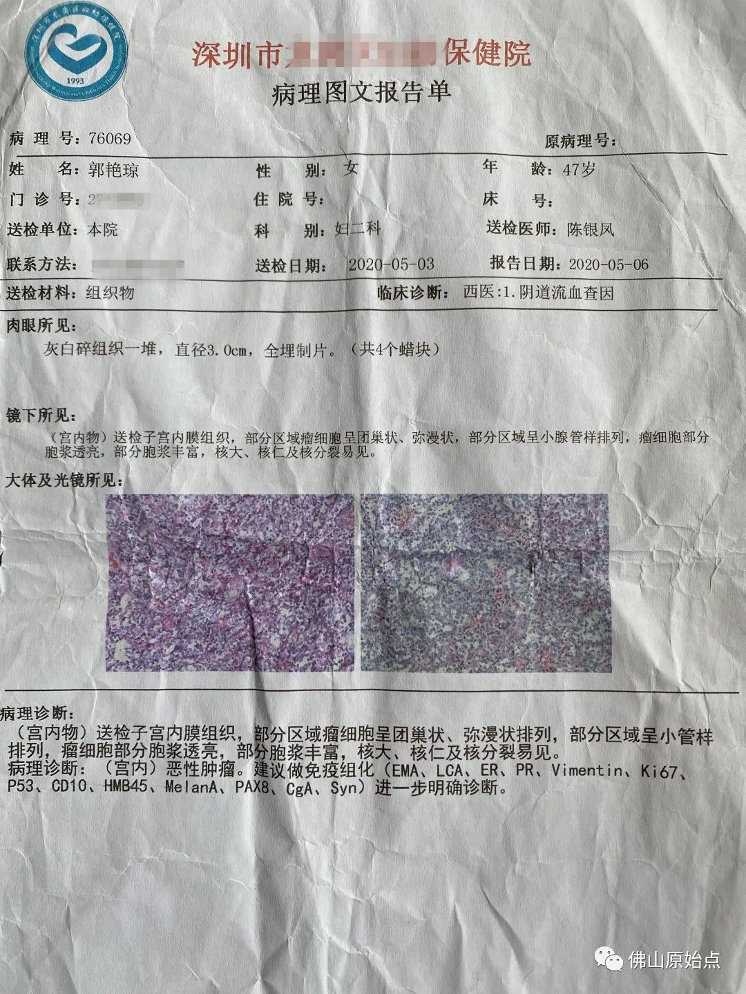 原始點調理子宮惡性腫瘤及全身多處疼痛案例