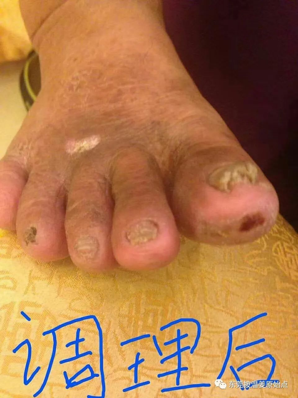 原始點處理糖尿病，腳趾腐爛不愈合