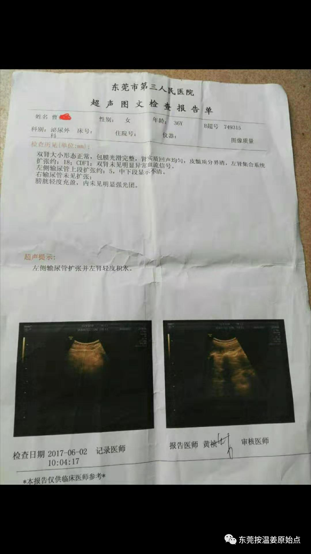 腎結石，輸尿管擴張，腎輕度積水