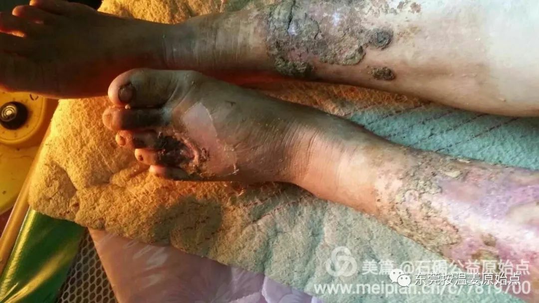 高血糖，雙腿腐爛不愈合，西醫認為需截肢