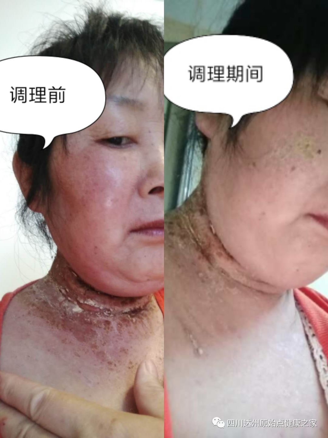 【原始點案例】原始點調理神經性皮炎