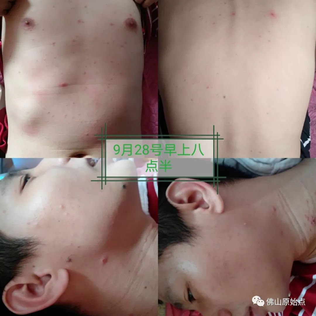 原始點調理水痘案例
