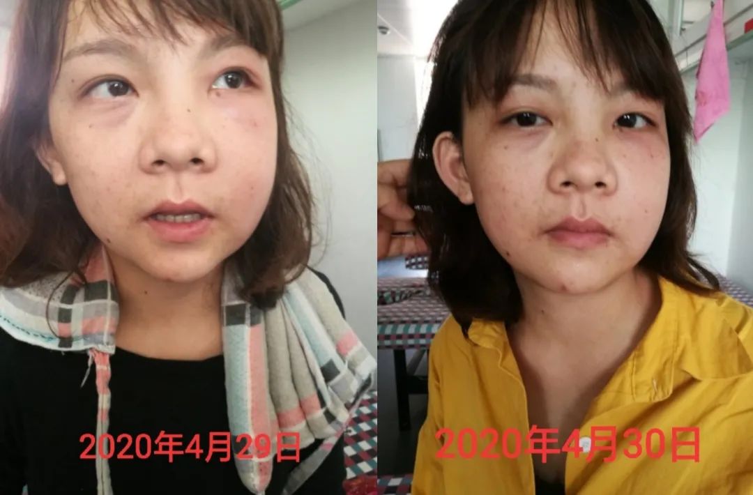 原始點調理牙痛、臉腫案例 原始點調理牙痛、臉腫案例