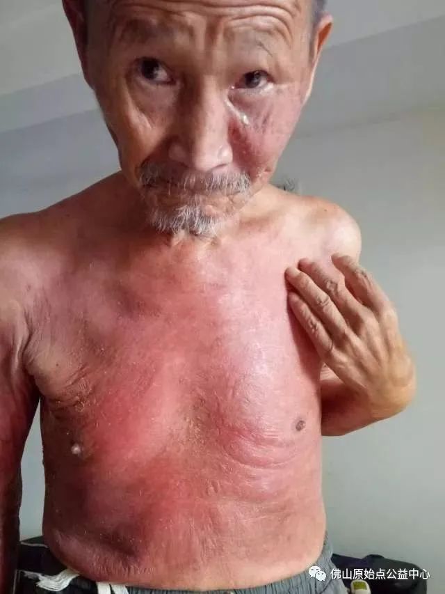 原始點調理全身腫脹潰爛:九個月,雨過天睛 原始點調理全身腫脹潰爛:九個月,雨過天睛