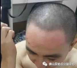 原始點調理九年史牛皮癬：二十天大變化